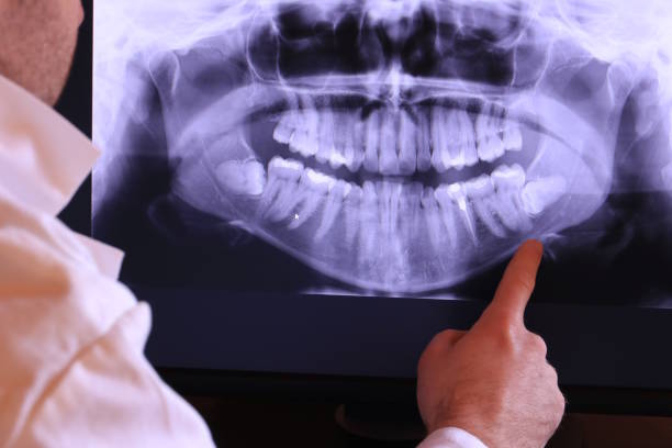 Best Emergency Wisdom Tooth Extraction in Bullhead City, AZ